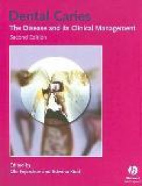 Dental caries the disease and its clinical management